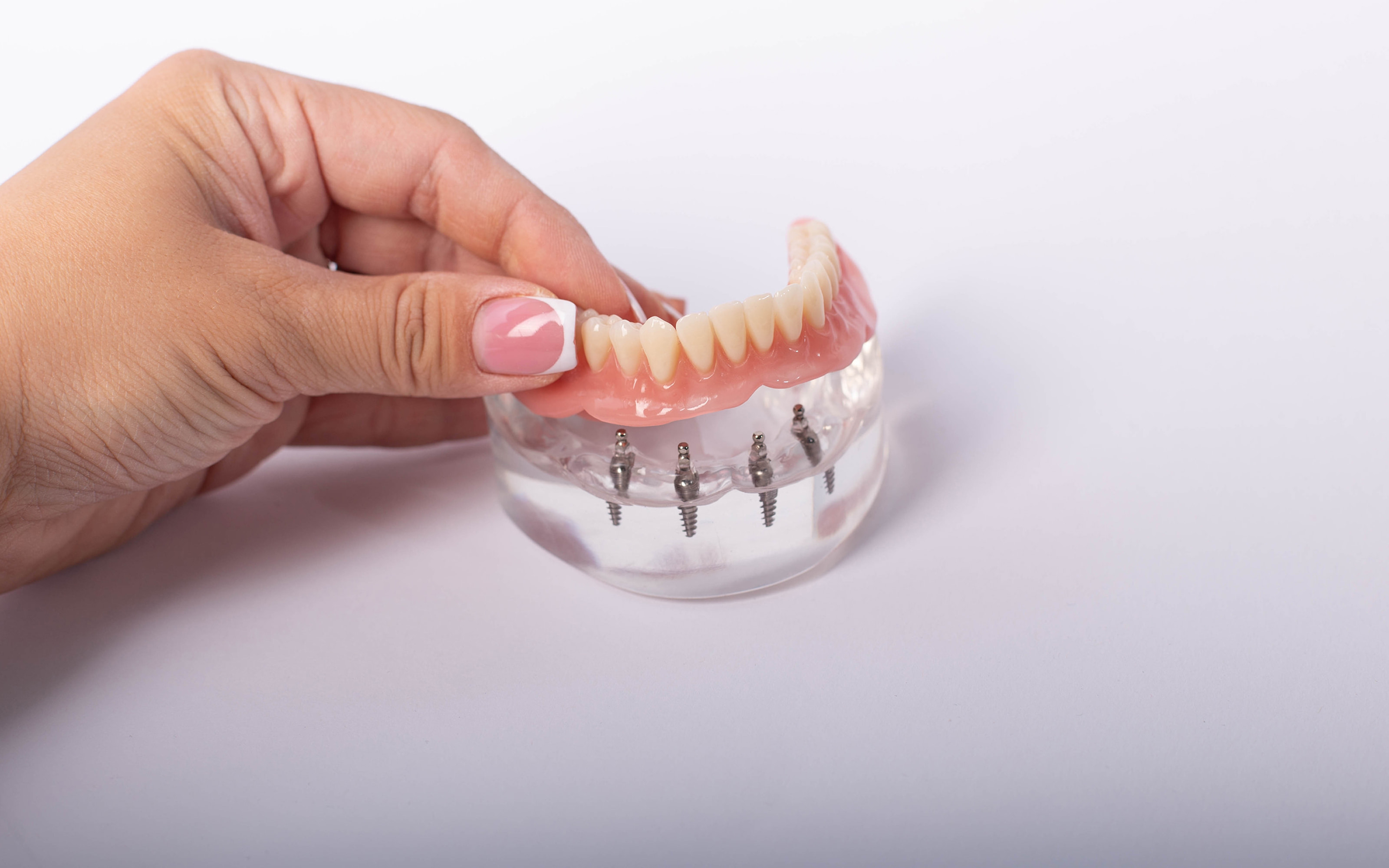 All-on-4 dental implants