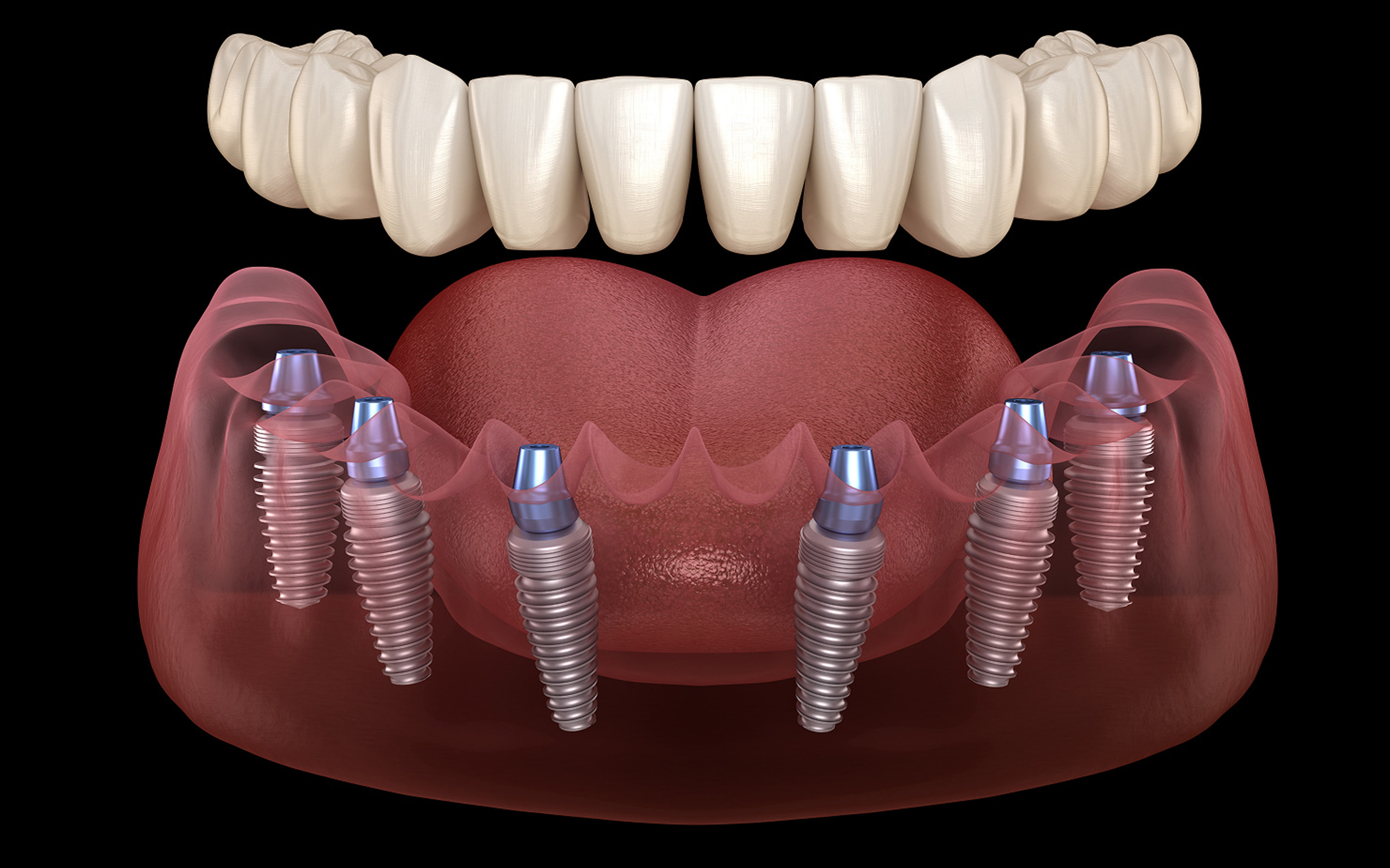 All-on-6 dental implants