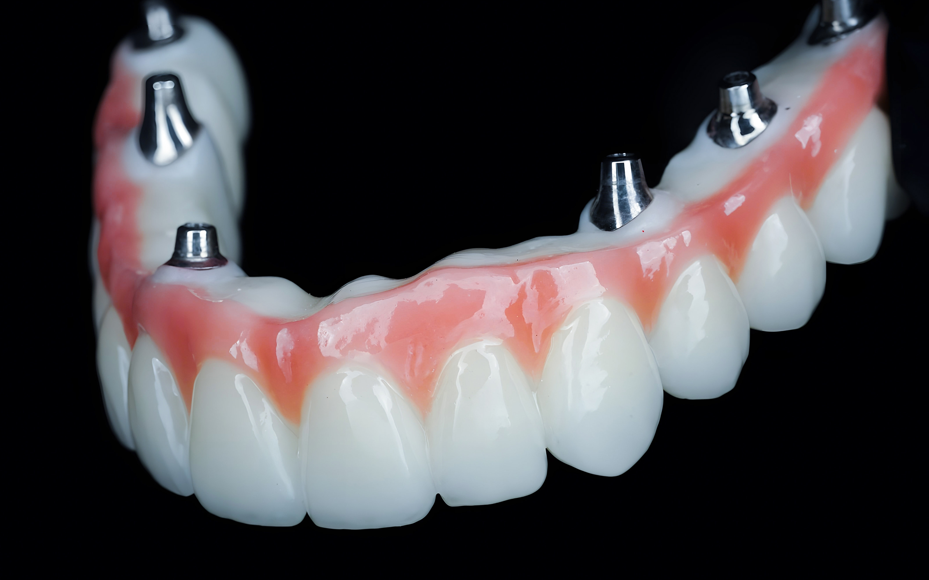 Full arch dental implants