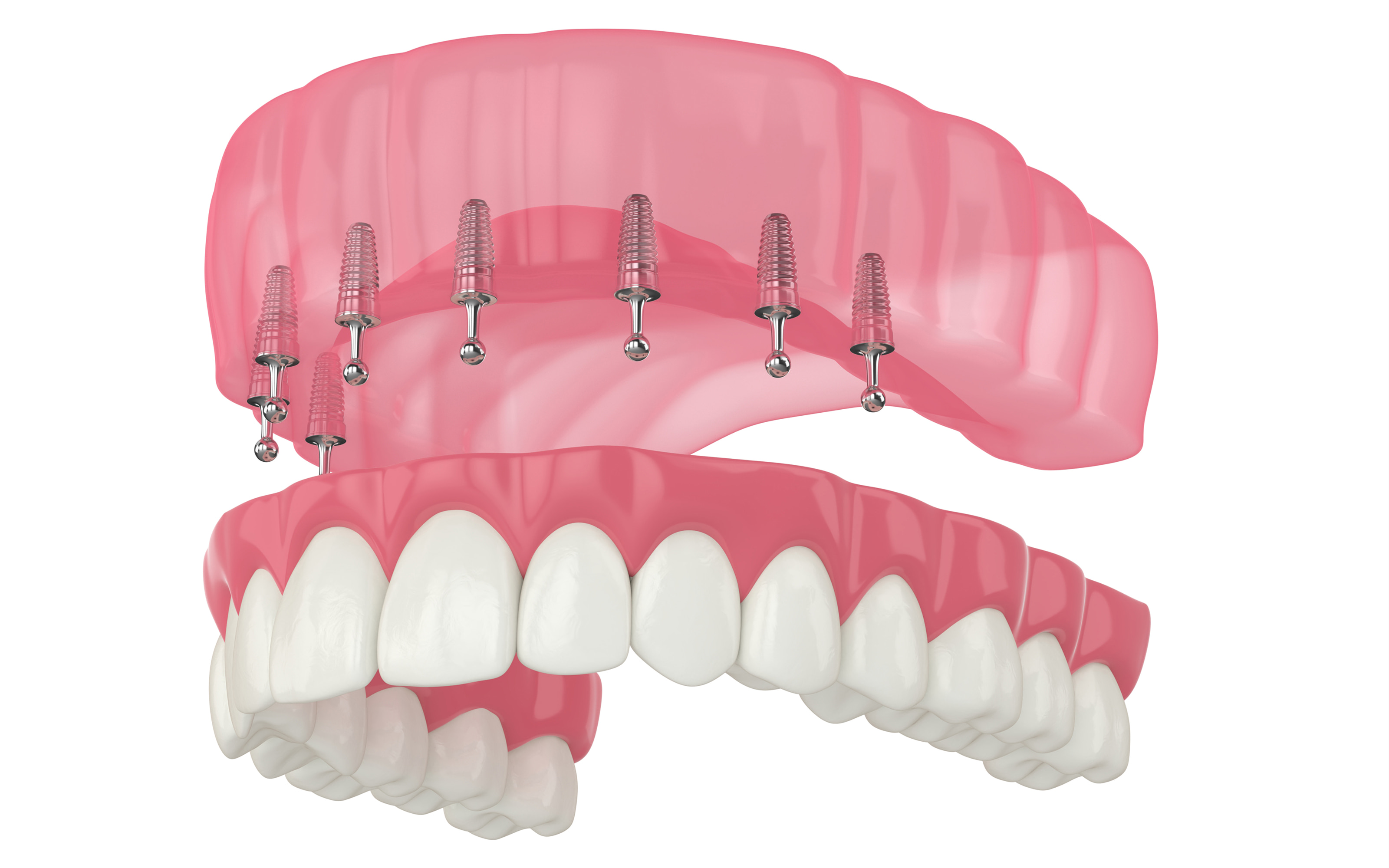 Snap-in dentures