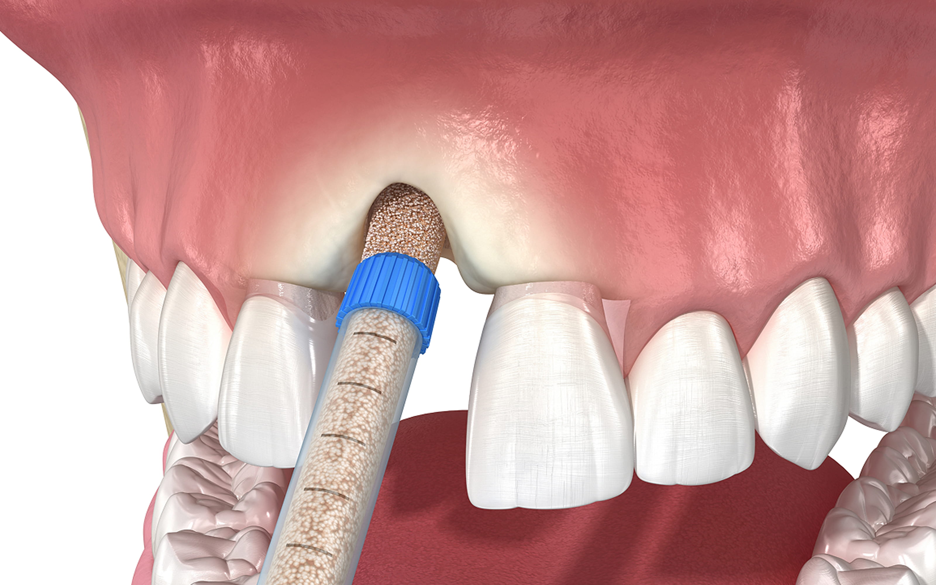 What is bone grafting