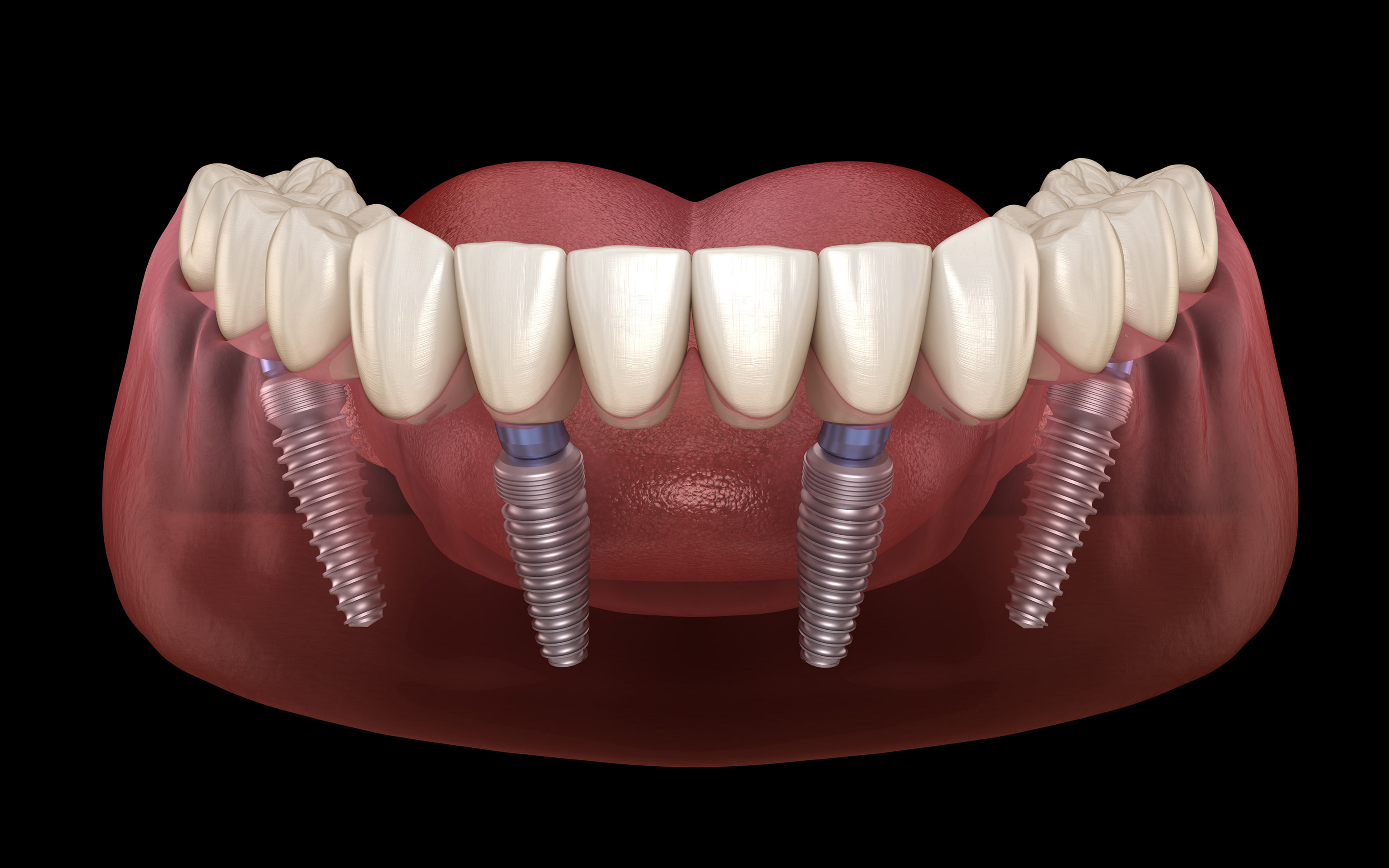 What are dental implants