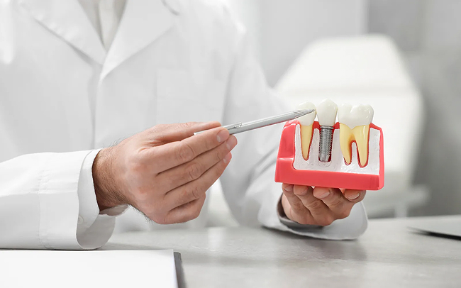 All-on-4 Dental Implants