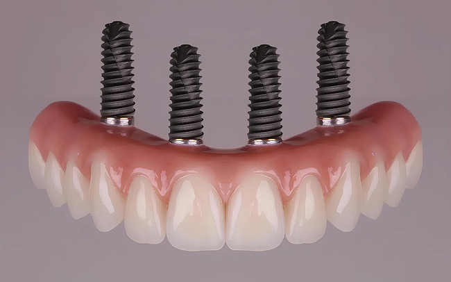 Teeth in a Day