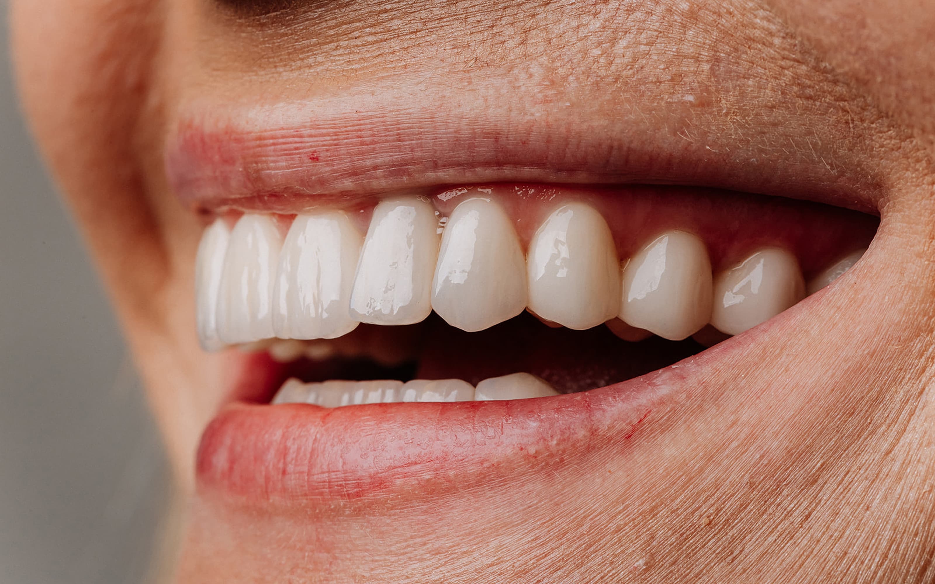 Full arch dental implants