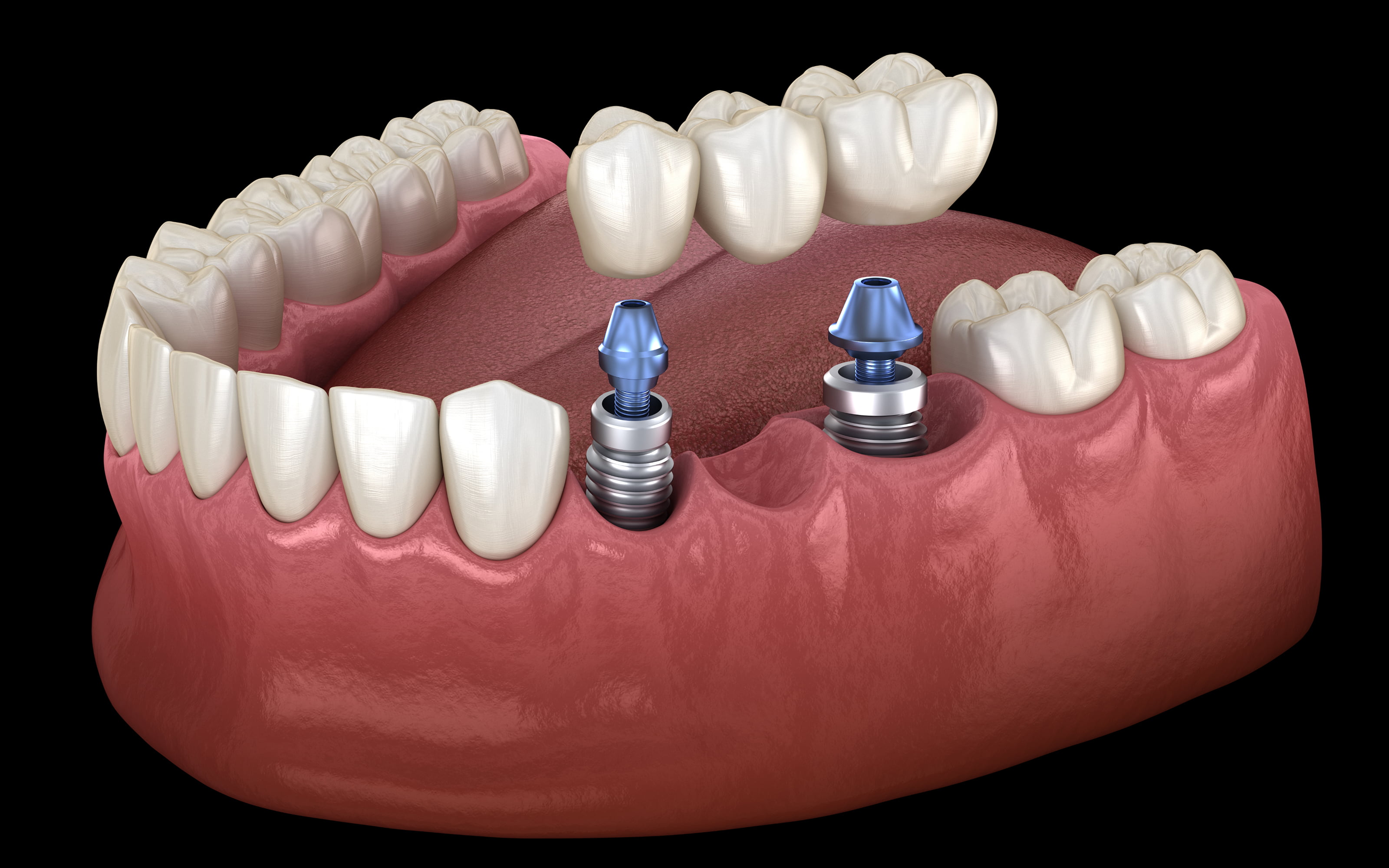 Implant-supported bridges