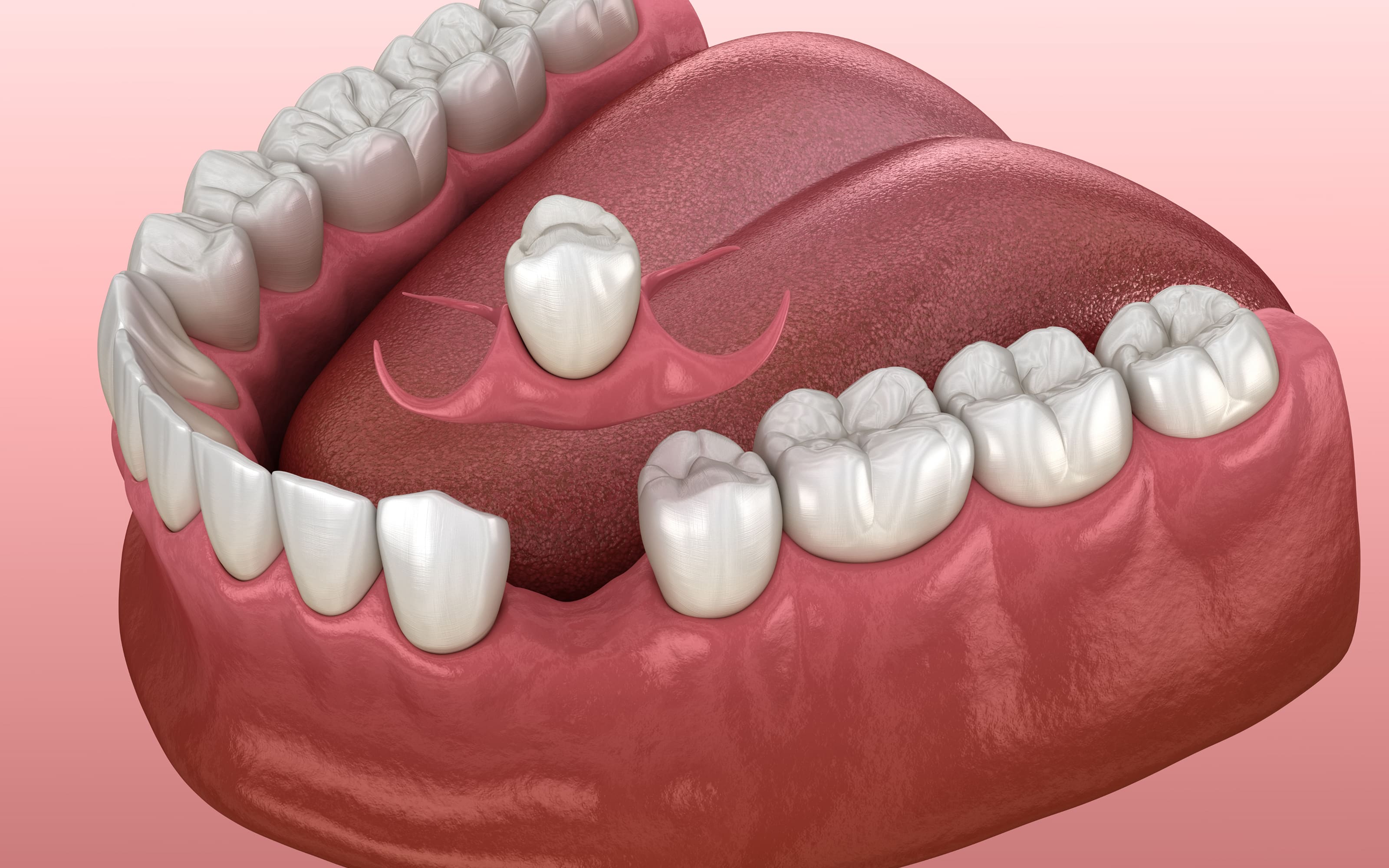Dental implants a long-term solution