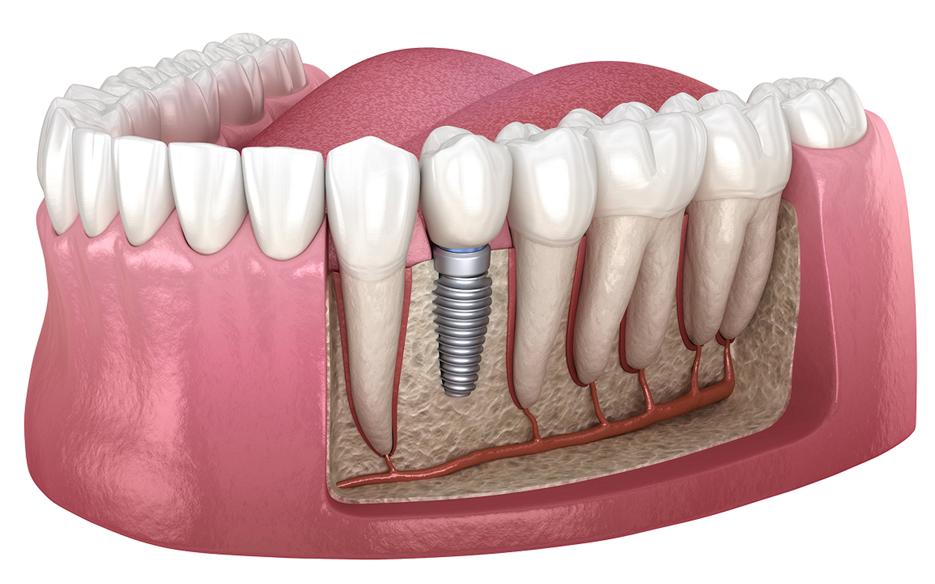 Single tooth dental implant components