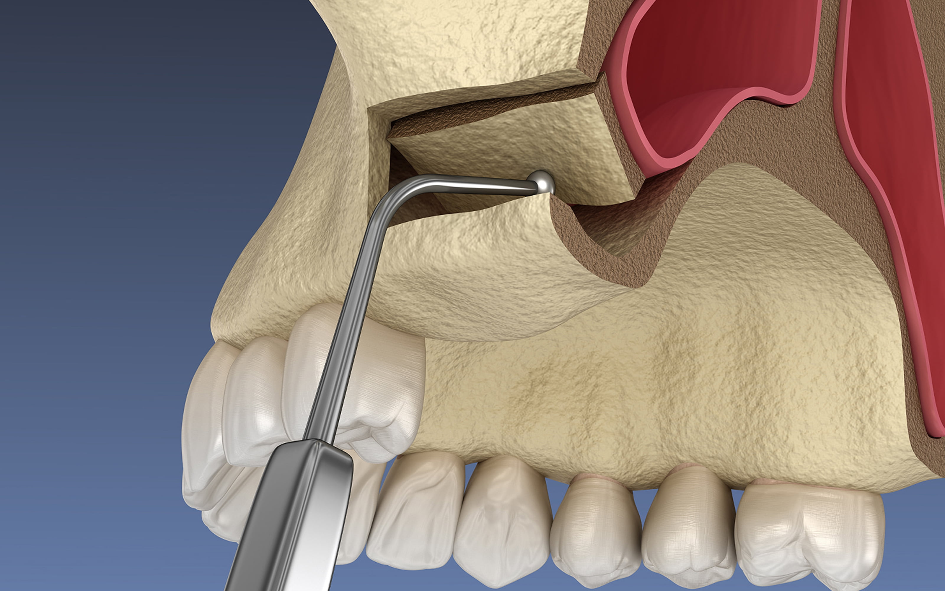 What is a sinus lift